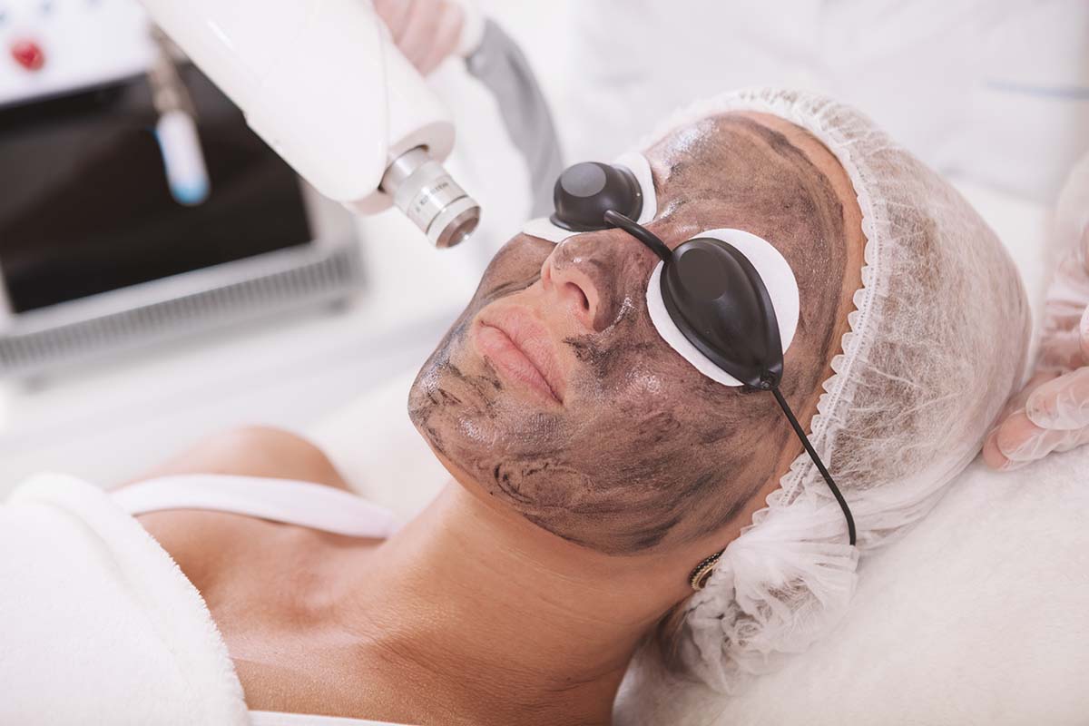 carbon laser facial