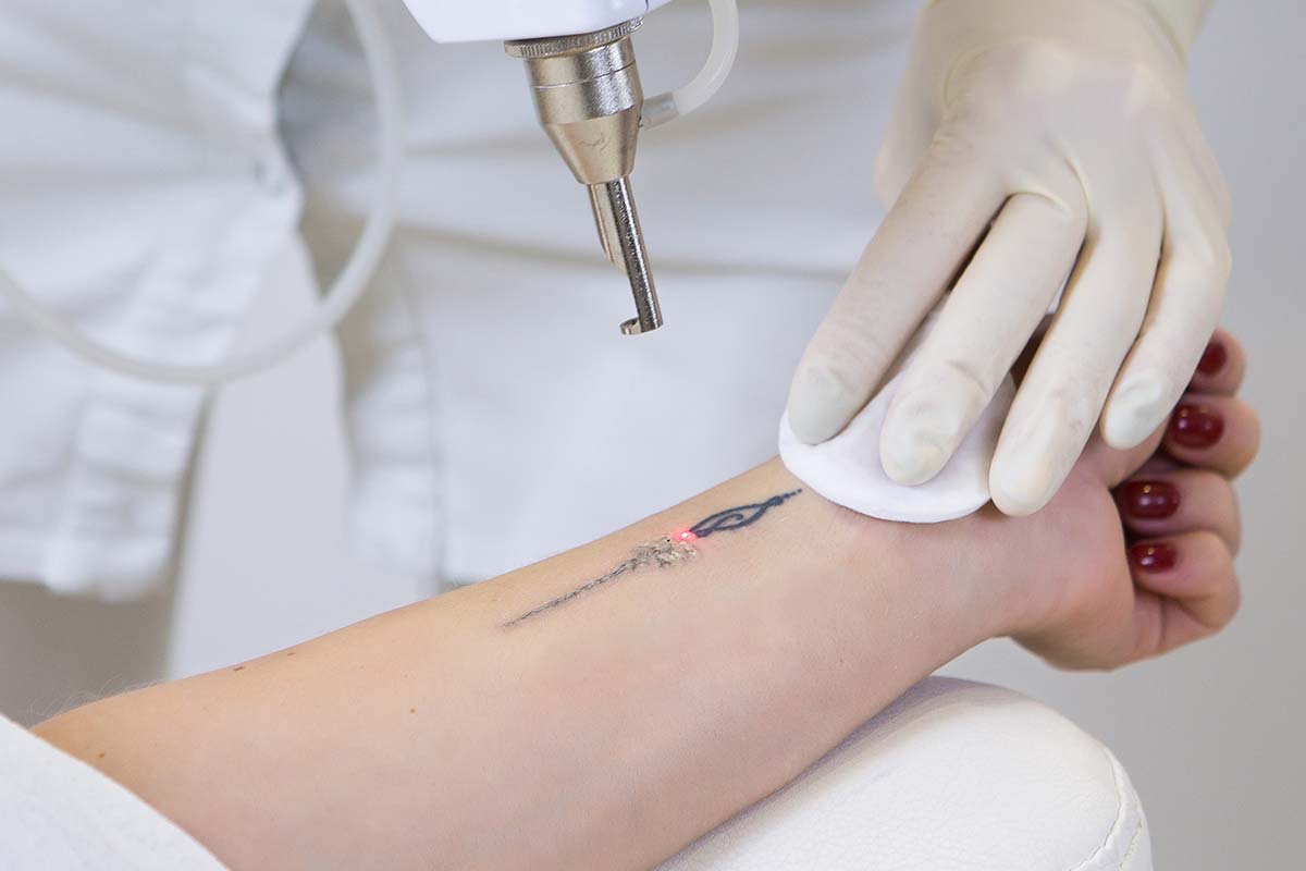 megandco_lasertattooremoval laser tattoo removal