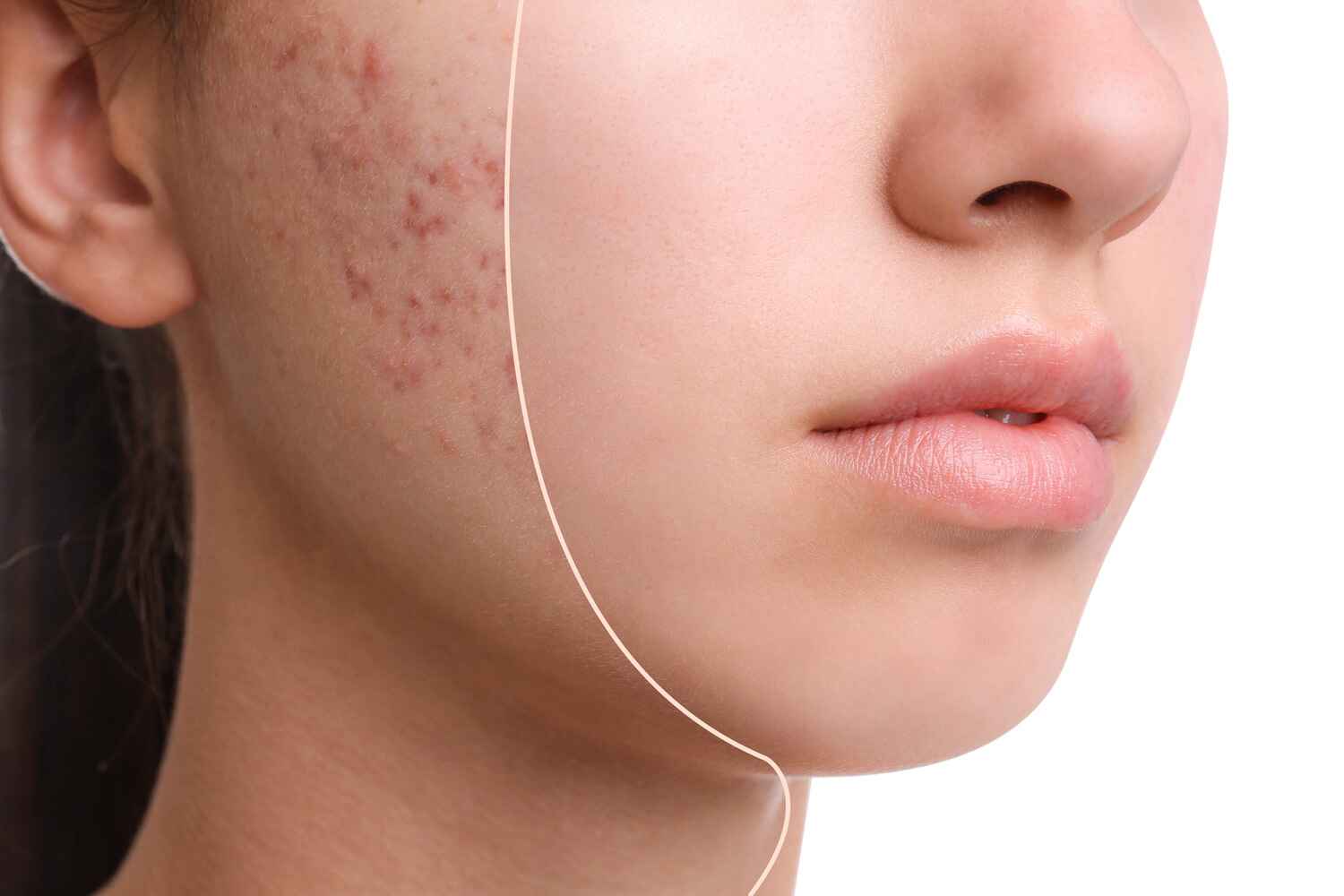 What Is Acne and What Causes It?