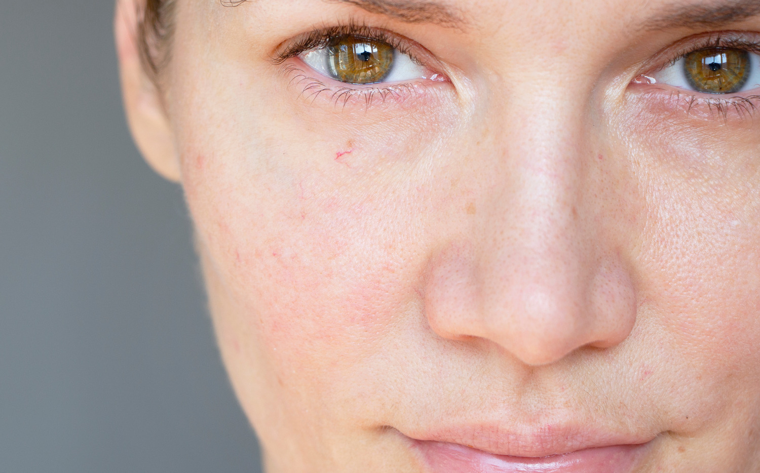 AdobeStock_319423658 What Are Broken Capillaries and What Causes Them?