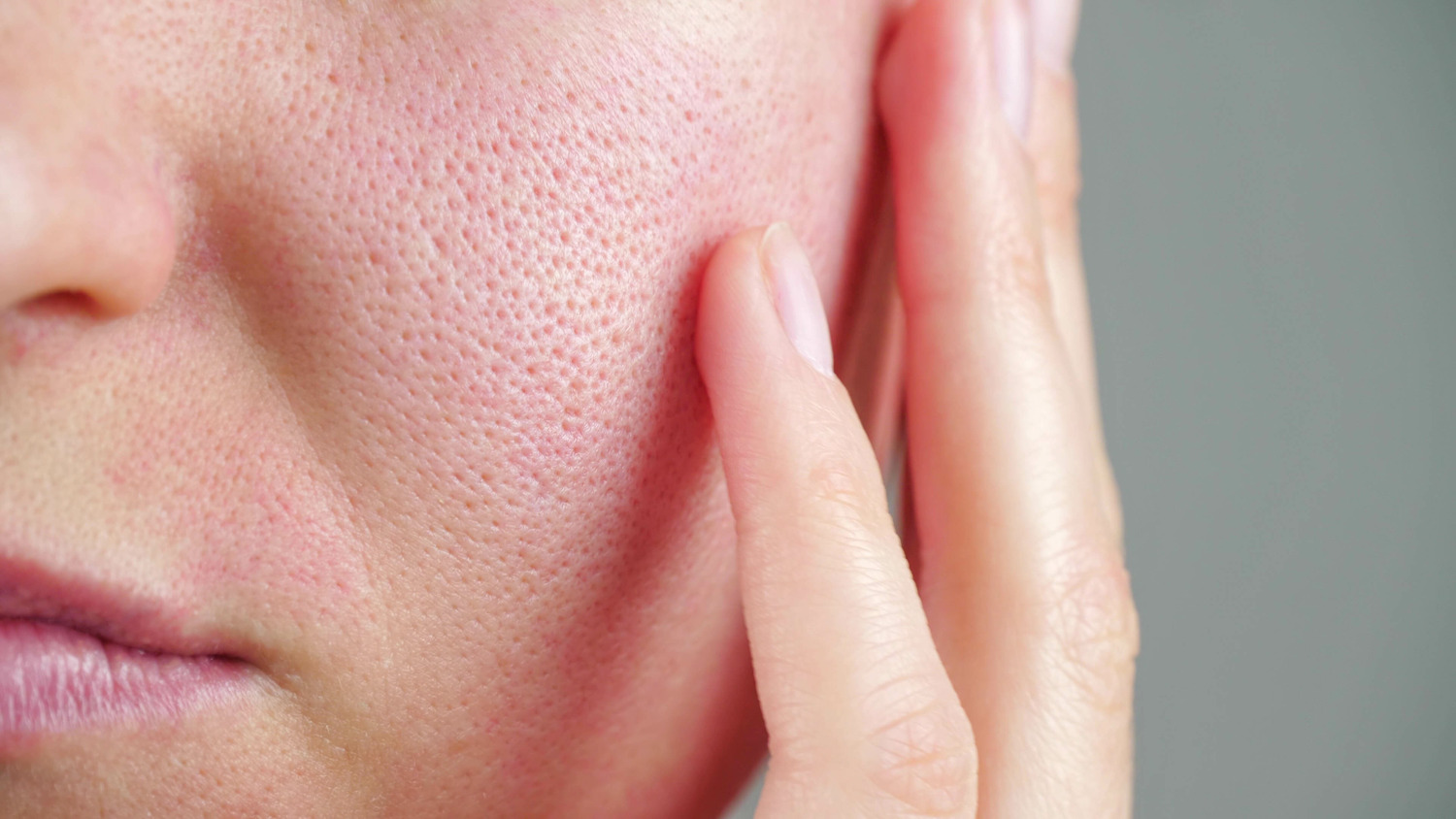 AdobeStock_410963882 Enlarged Pores vs. Acne Scars