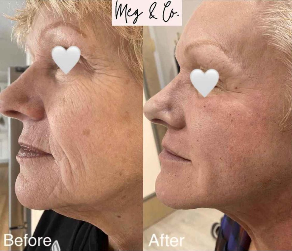 Genius Rf Microneedling To Treat Wrinkles Scars And More Meg And Co