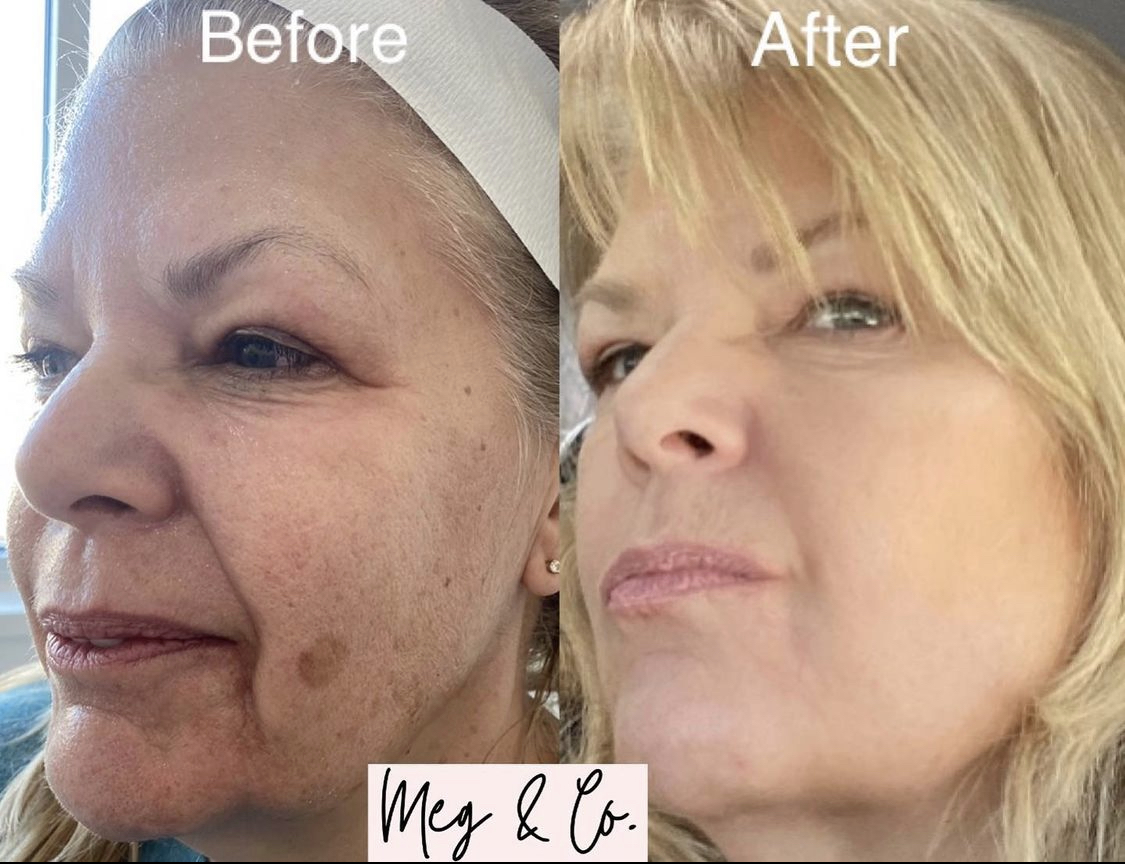 Genius RF Microneedling before and after, showing it as a beauty solution