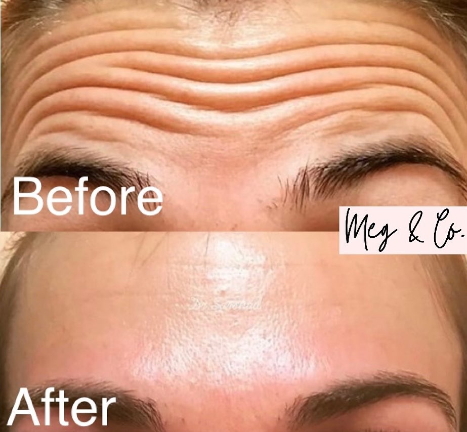 Botox before and after showing diminished wrinkles