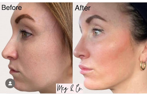 Dermal Fillers are a Way to Embrace a Refreshed and Youthful Appearance