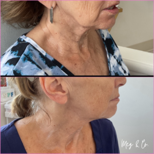 Before and after of Microneedling client